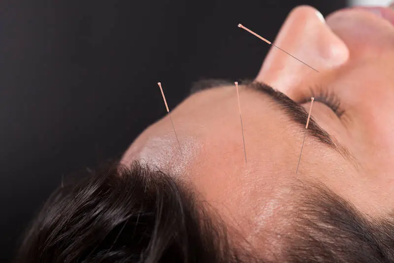 Porażenie nerwu twarzowego (Bell’s Palsy) – czy akupunktura może pomóc?